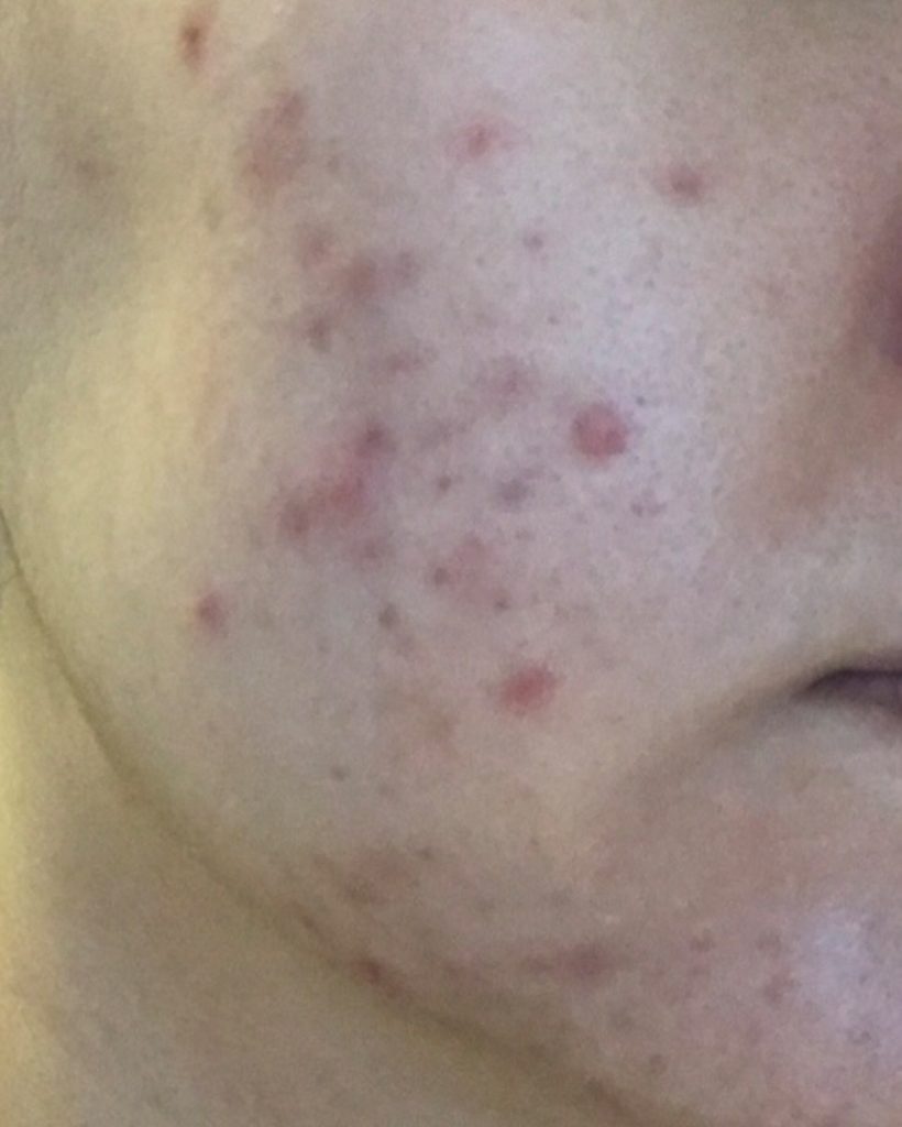 Angry red pimples breaking out on cheeks from hormonal acne and stress