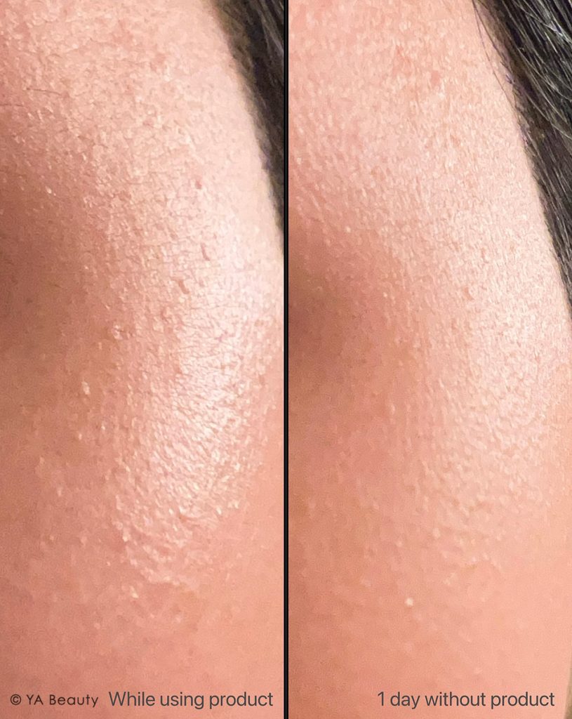 Fermented skincare caused my acne breakouts, starting from very small colorless bump like dots on face, on the left is how it looks like while using the product, and on the right is how the skin is already smoother after 1 day of cutting out the skincare.