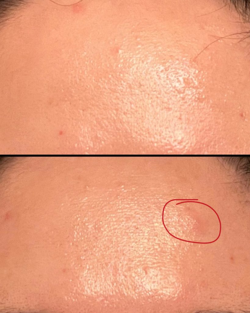 Deep, painful and almost colorless cyst acne on the forehead caused by fermented skincare ingredients. 